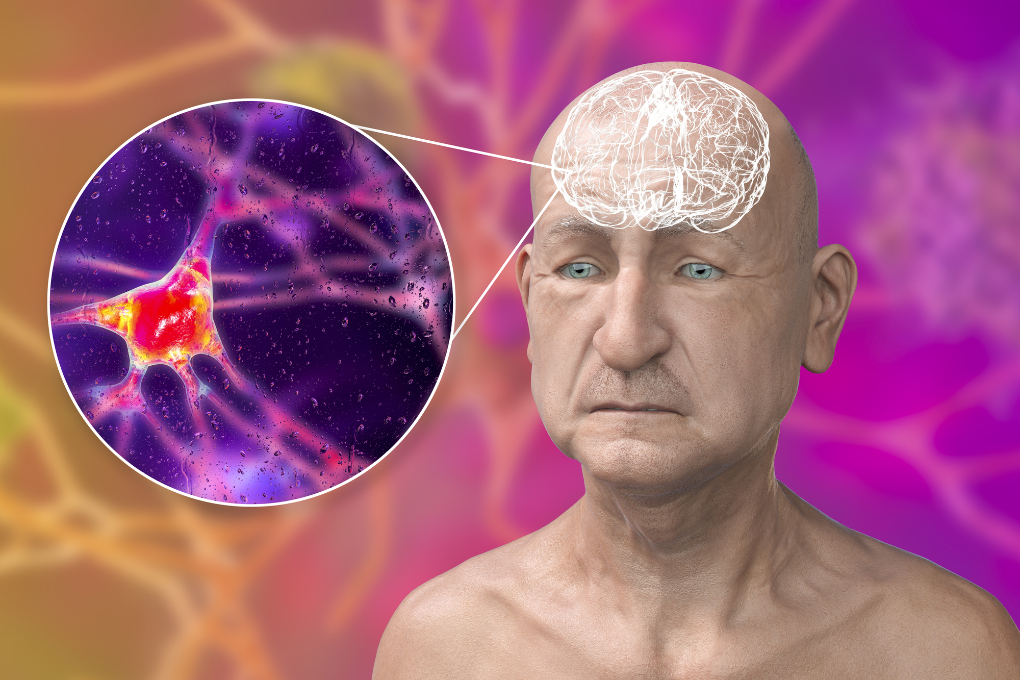 Tipos de Demência Frontotemporal